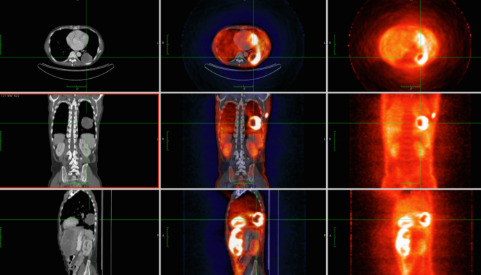 What is a PET Scan The Best Vital Imaging Technique
